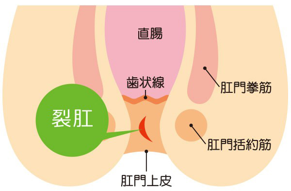 裂肛（切れ痔）