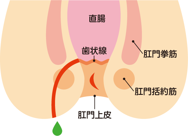 穴痔（痔ろう）