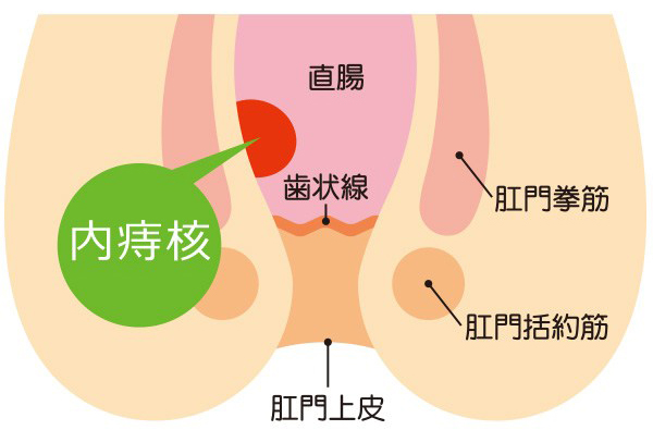 いぼ痔（内痔核）によくある症状