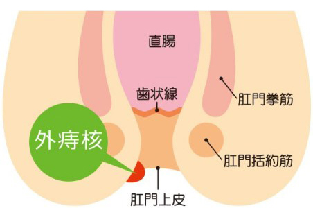 いぼ痔（外痔核）によくある症状